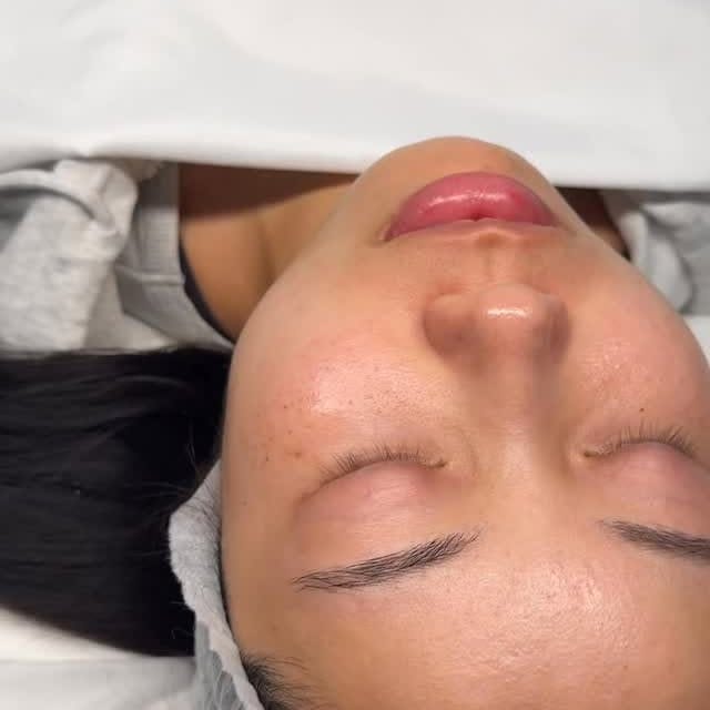 Hydrafacial in progress