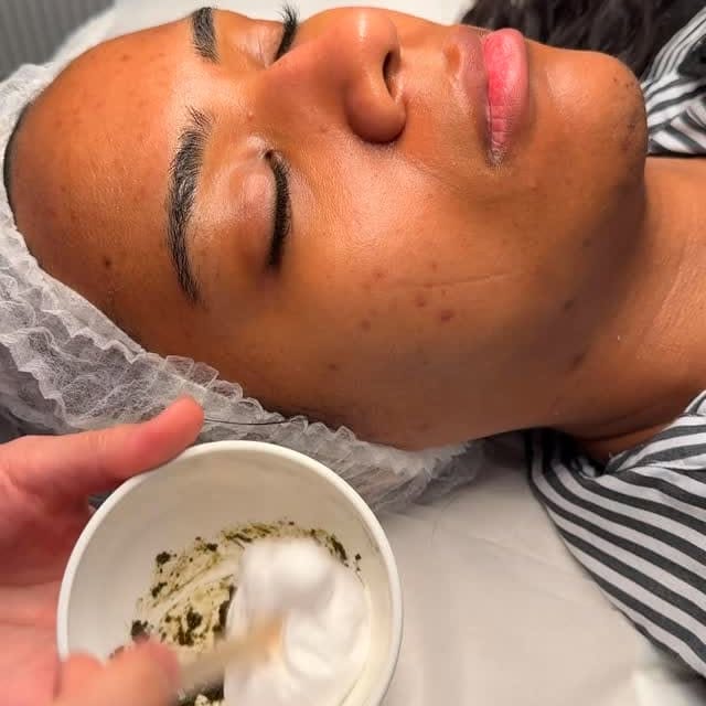 Green Peel treatment
