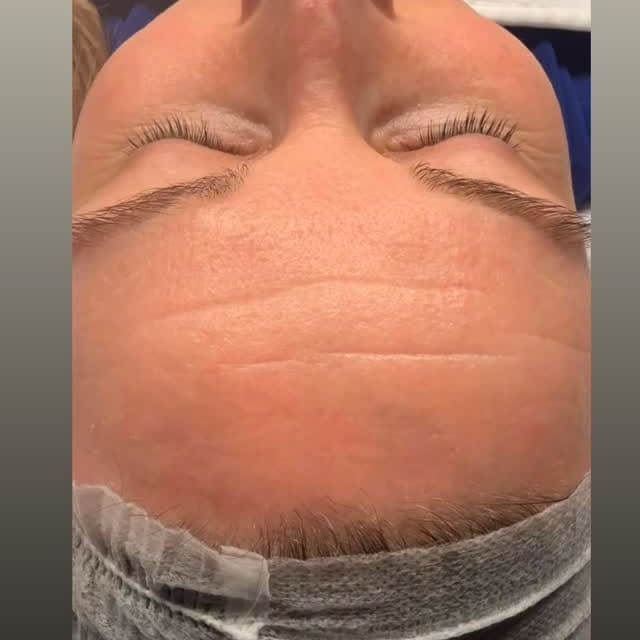 Platinum Hydrafacial