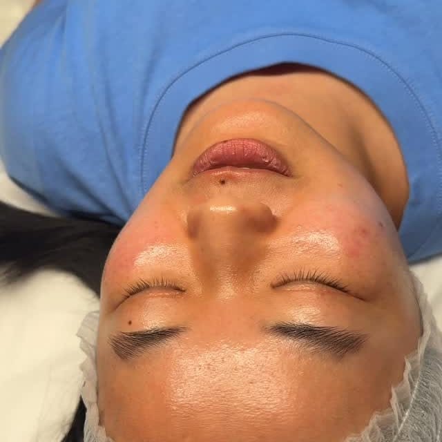 Signature Hydrafacial result